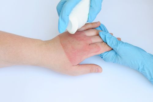 Understanding the Classification of Burn Injuries
